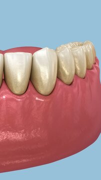 Periodontal - pathological inflammatory condition of the gum in progress. Dental 3D Animation