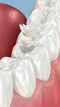 Inlay ceramic crown placement. 3D animation
