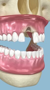 Bone grafting augmentation, socket preservation, tooth implantation. Medically accurate 3D animation
