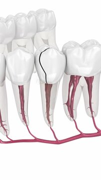 Cracked tooth, splitted. Dental 3D animation