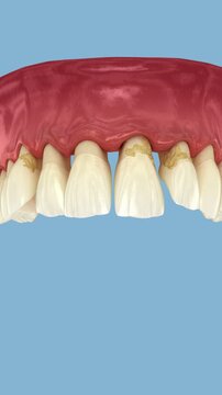Periodontitis and gum recession in dynamics, teeth losing. Dental 3D animation 
