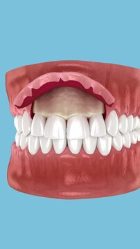 Frontal gum line correction, surgery, Esthetic surgery. Dental 3D animation