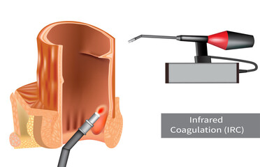 Minimally Invasive Hemorrhoid Therapy Using Infrared Coagulation Device. Anoscopic View of IRC Hemorrhoid Procedure. Treatment for Hemorrhoids