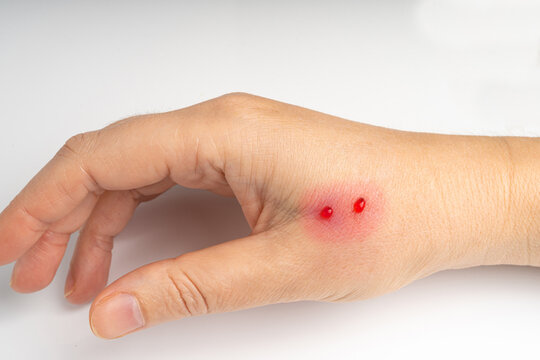 Snake bite on skin, snakebite or cat bite marks close up. Two small fresh blood drops on hand