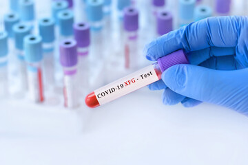 Fototapeta premium Gloved hand holding a labeled test tube with a blood sample for COVID‑19 Variant XFG ( Stratus), surrounded by blurred test tubes in a medical laboratory setting.