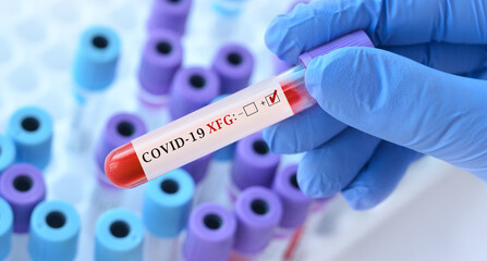 Gloved hand holding a labeled test tube with a blood sample for COVID‑19 Variant XFG ( Stratus), surrounded by blurred test tubes in a medical laboratory setting.
