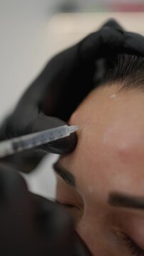 Close-up of cosmetic injections in the forehead. Concept of rejuvenation procedure.