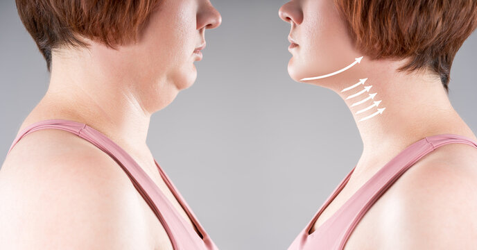 Double chin lifting, neck liposuction, facelift and plastic surgery, before after anti aging skin rejuvenation, wrinkle treatment concept