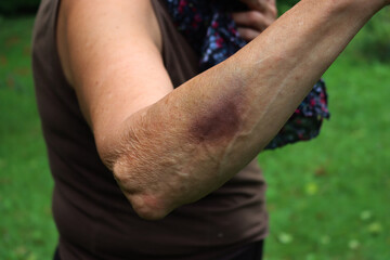 Naklejka premium Close-up of adult woman’s arm with big hematoma after a injury