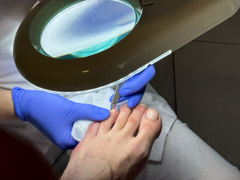 A podiatrist in a white coat and blue medical gloves performs a man's pedicure at a beauty salon. Professional men's pedicure in the salon. A podologist treats an ingrown toenail in blue gloves. 