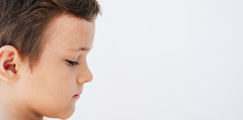 Spots, blisters and a rash on the boy's face, as symptoms of the Coxsackie virus.