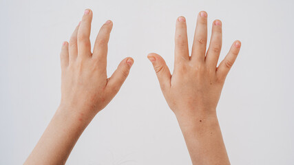 Rash and red blisters on the skin of a child's hands caused by the Coxsackie virus.
