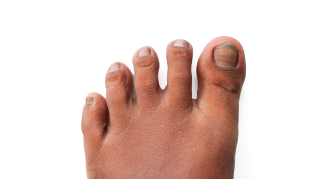 A close-up view of the top of a foot with the toes, showcasing a foot with bruised toenails, highlighting a medical or cosmetic issue.