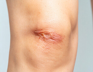 Fototapeta premium Close-up of a human knee with a prominent scar, skin texture visible.