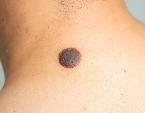 Close-up of a large, dark mole on a person's back skin.
