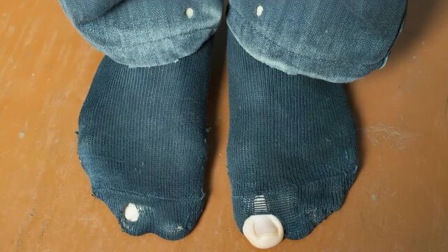 Poverty impacts visible through worn and torn socks