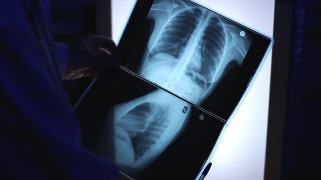 Woman's chest x-ray. Doctor and x-ray. X-ray.. Slow motion. High quality 4K video recording.