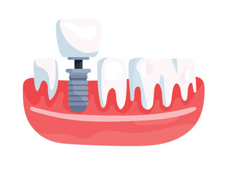 Model of the jaw part with a row of teeth and a dental implant. Installation of a crown. Flat vector clipart, illustration with isolated background.