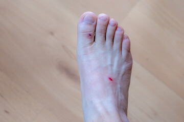 Healthcare and medical concept, Selective focus of right hand side foot with contusion, Man with...