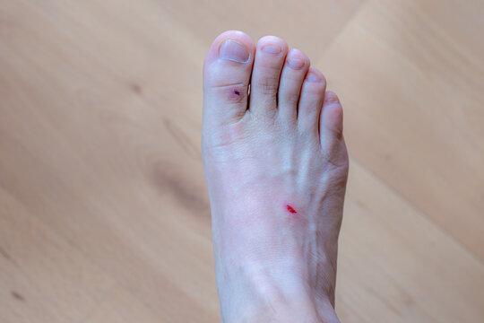 Healthcare and medical concept, Selective focus of right hand side foot with contusion, Man with showing a little lesion on his feet, Accident wound marks insult.