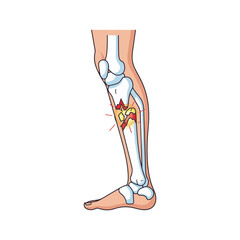Illustration depicting a fractured tibia and fibula in a human leg, showcasing bone breakage and damage.