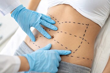 Abdominal liposuction markings, doctor's hands pointing, cosmetic surgery