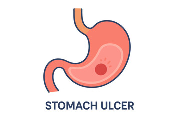 Obraz premium Stomach ulcer illustration in flat design style with pink color stomach ulcer diagram