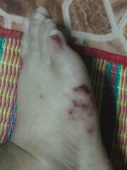 Feet covered in millipede marks