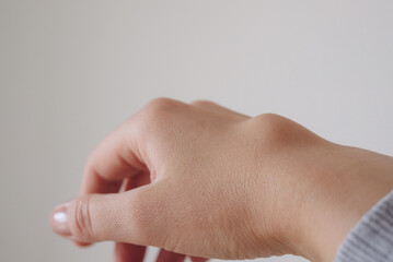 Female right back hand with ganglion cyst on the dorsum,  fluid-filled bump associated with a joint or tendon sheath, close-up view, selected focus.