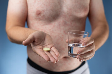 Fototapeta premium The shot shows a body covered with a widespread red rash, emphasizing the severity of the condition. In his hand, the patient holds tablets, symbolizing the effort to treat and manage the rash symptom