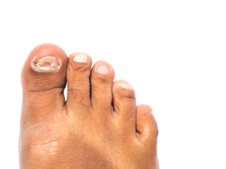 Unhealthy feet with cracked and peeling toe, dry dark skin in close up Isolated on Transparent Background.	