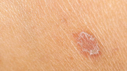 Fototapeta premium Close-up of dry, flaky and red human skin, showing symptoms of psoriasis, eczema or dermatitis.