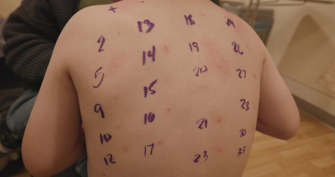 Allergy Testing on a Child