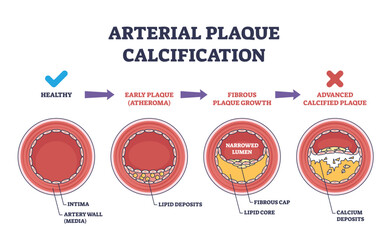 Arterial plaque calcification shows artery cross-sections with plaque buildup, narrowed lumen, and calcium deposits. Outline diagram