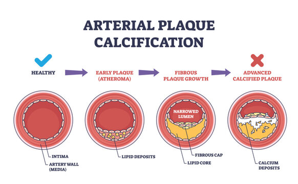 Arterial plaque calcification shows artery cross-sections with plaque buildup, narrowed lumen, and calcium deposits. Outline diagram