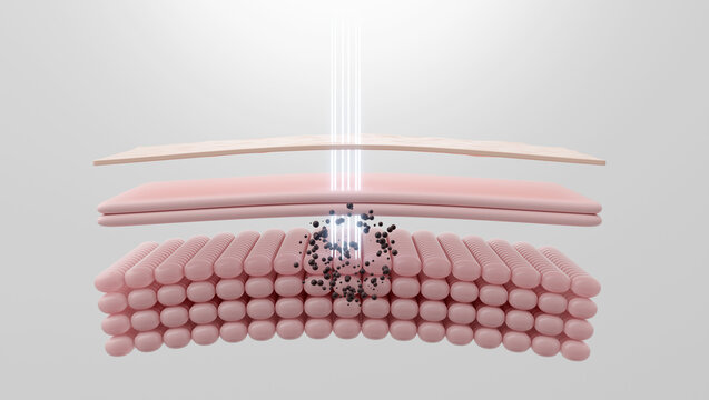 Pico laser shattering pigmentation for dark spot removal 3D