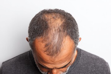 Fototapeta premium Bald spot on top of head