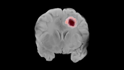 Coronal view of a human brain in grayscale showing a glioblastoma tumor as a dark maroon mass with a pink halo in the left cerebral hemisphere against a black background.