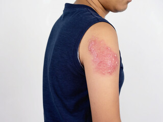 Shingles rash on the arm of a man isolated on white background