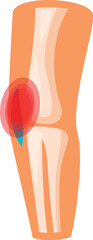 Medical illustration showing elbow bones and ligaments experiencing pain