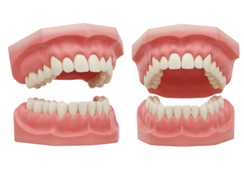Four dental models demonstrating healthy gums teeth and orthodontic braces for dental education transparent background