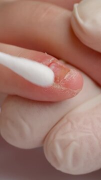 Macro shot of a damaged fingernail with peeling skin and redness around the nail bed, being cleaned or treated with a cotton swab by a person wearing medical gloves.
