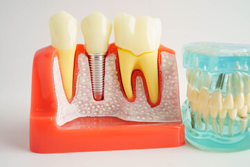 Obraz premium Dental teeth model on white background for learn about dentistry.