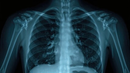 Imaging shows left lung tension pneumothorax with resultant mediastinal shift; patient requires prompt chest tube placement.