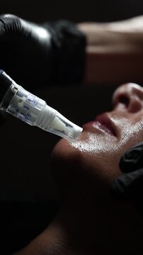 woman receiving microneedling in spa 