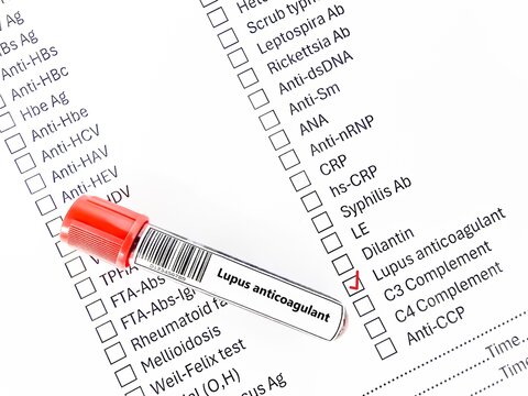 Blood sample tube and paper order request for lupus anticoagulant test analysis.