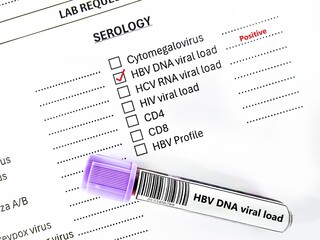 Blood sample tube positive result for HBV DNA viral load.