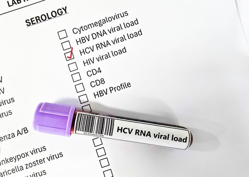 Blood sample tube and paper order request for HCV RNA viral load test analysis.