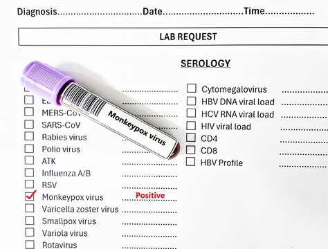 Blood sample tube positive result for HIV monkeypox virus test analysis. - Powered by Adobe