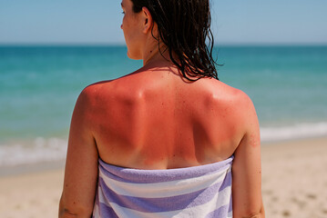 woman with sunburned shoulders wrapped in striped towel on a sunny beach day with clear blue sky and sea